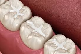 Fillings & Sealants